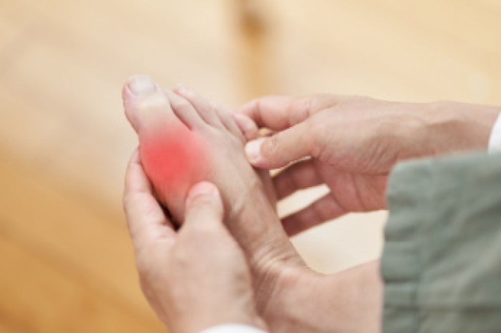 Understanding Gout Risk Factors