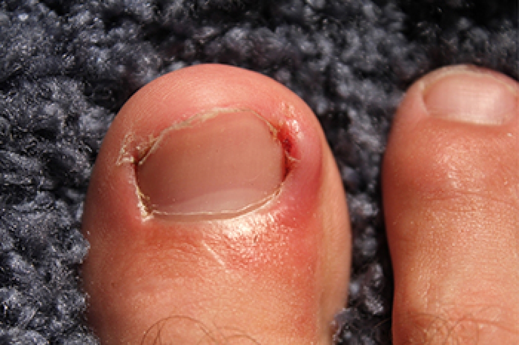 Recognizing an Infected Ingrown Toenail