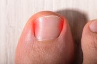 How Should I Trim My Toenails to Prevent Ingrown Nails?