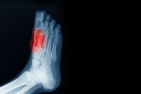Toe Pain May Be Caused by Sesamoiditis