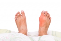The Different Types of Bunions