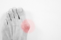 Can Bunions Develop as a Result of Having Arthritis?