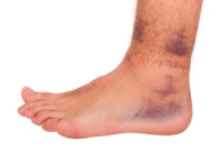 Distinguishing Between High and Low Ankle Sprains