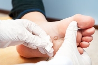Possible Treatments for Warts