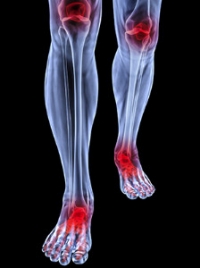 Rheumatoid Arthritis: Symptoms & Causes